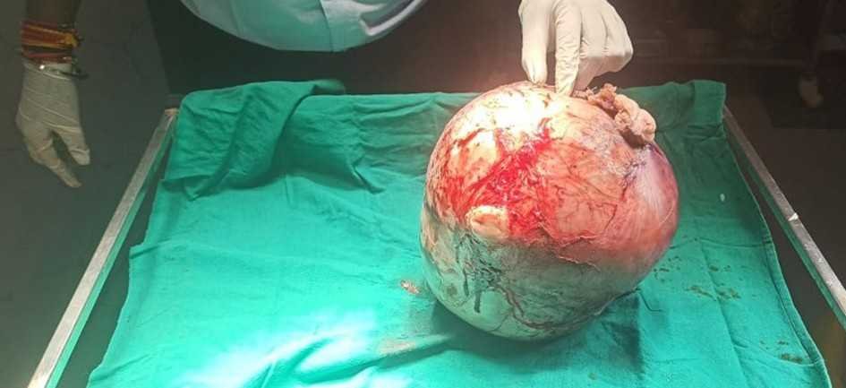 डॉक्टरों की टीम ने महिला के पेट से निकाला 7 किलो का ट्यूमर