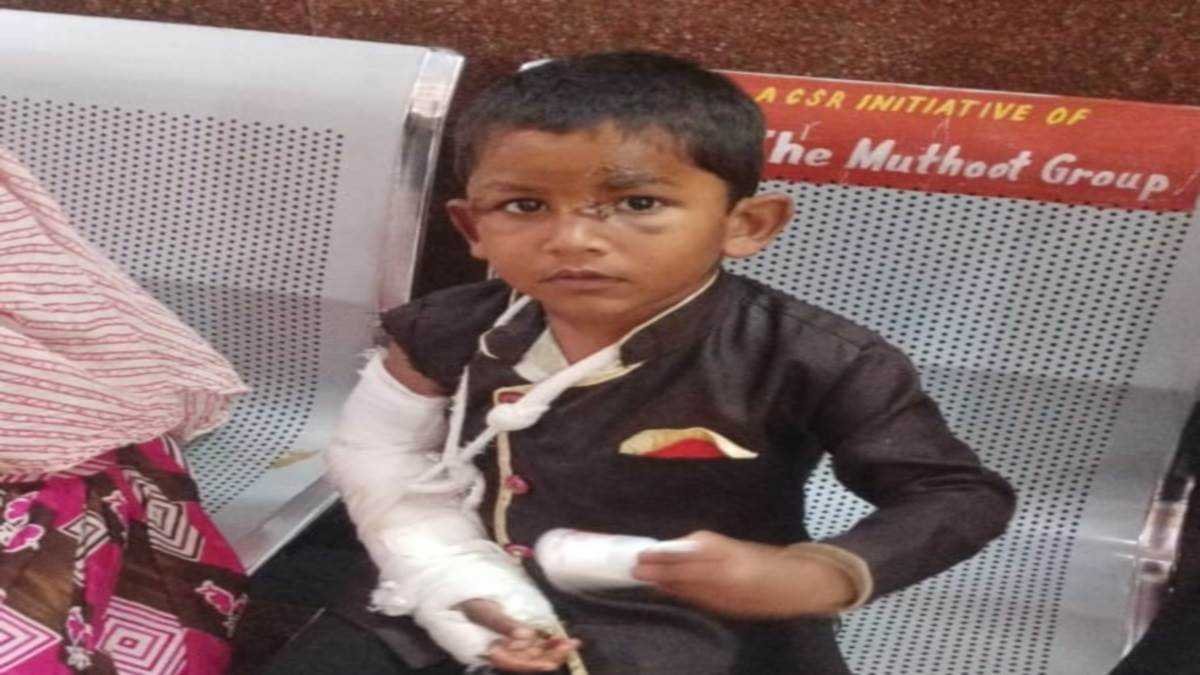 पांच साल के बच्चे पर श्वान ने हमला कर दिया, कई जगह काटा