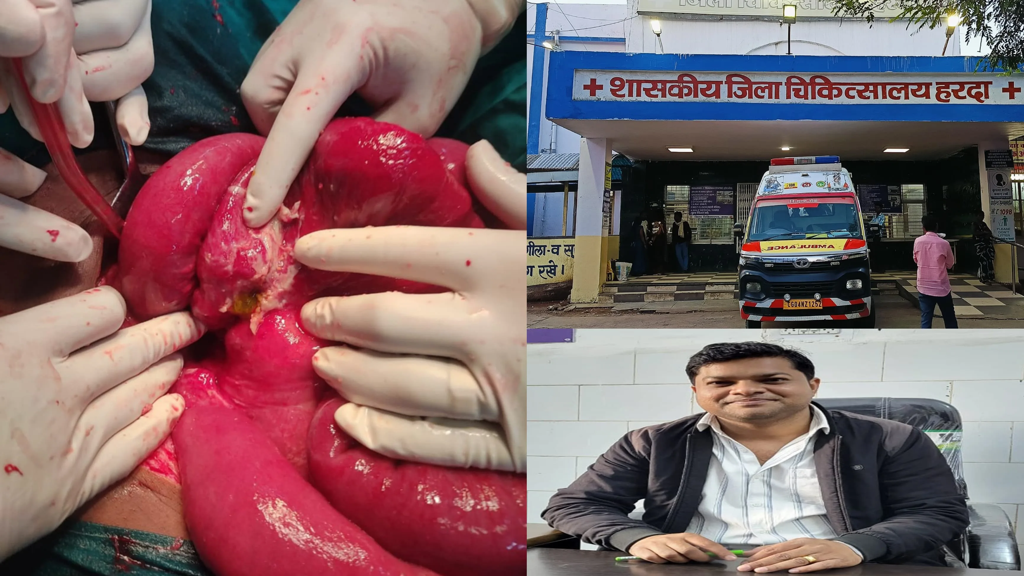 हरदा जिला अस्पताल में बड़ी आंत का हुआ सफल ऑपरेशन