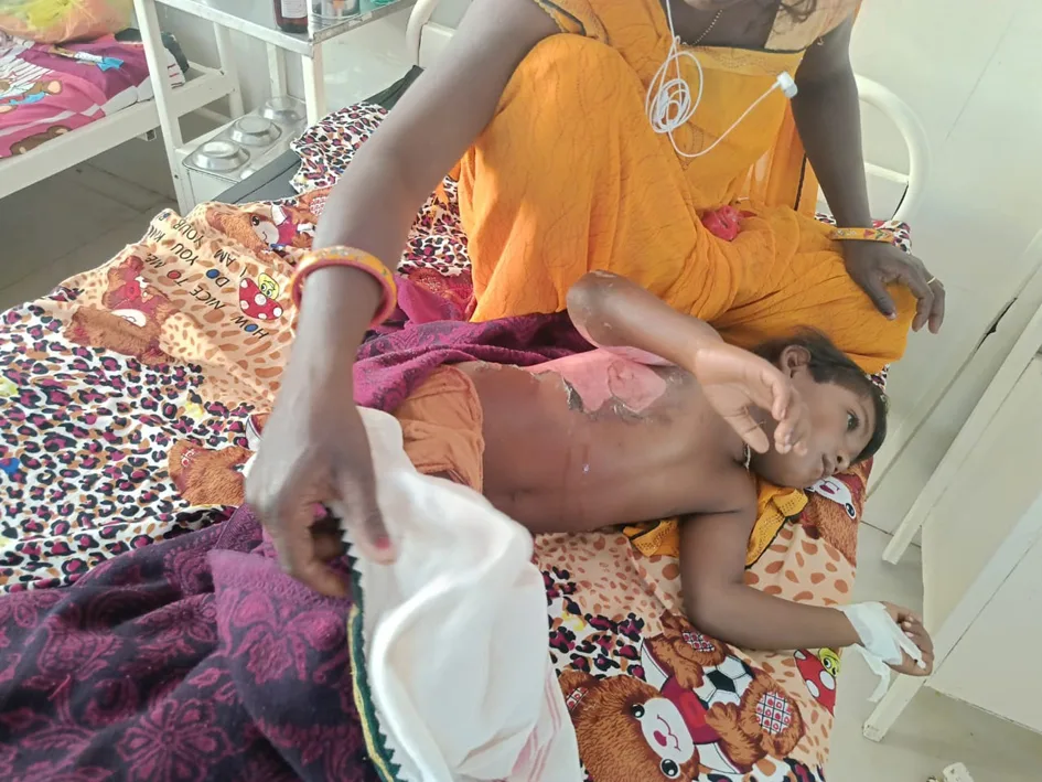 भाई के साथ खेल रही ५ वर्षीय बहन गर्म पानी की तपेल पर गिरी, अस्पताल में भर्ती