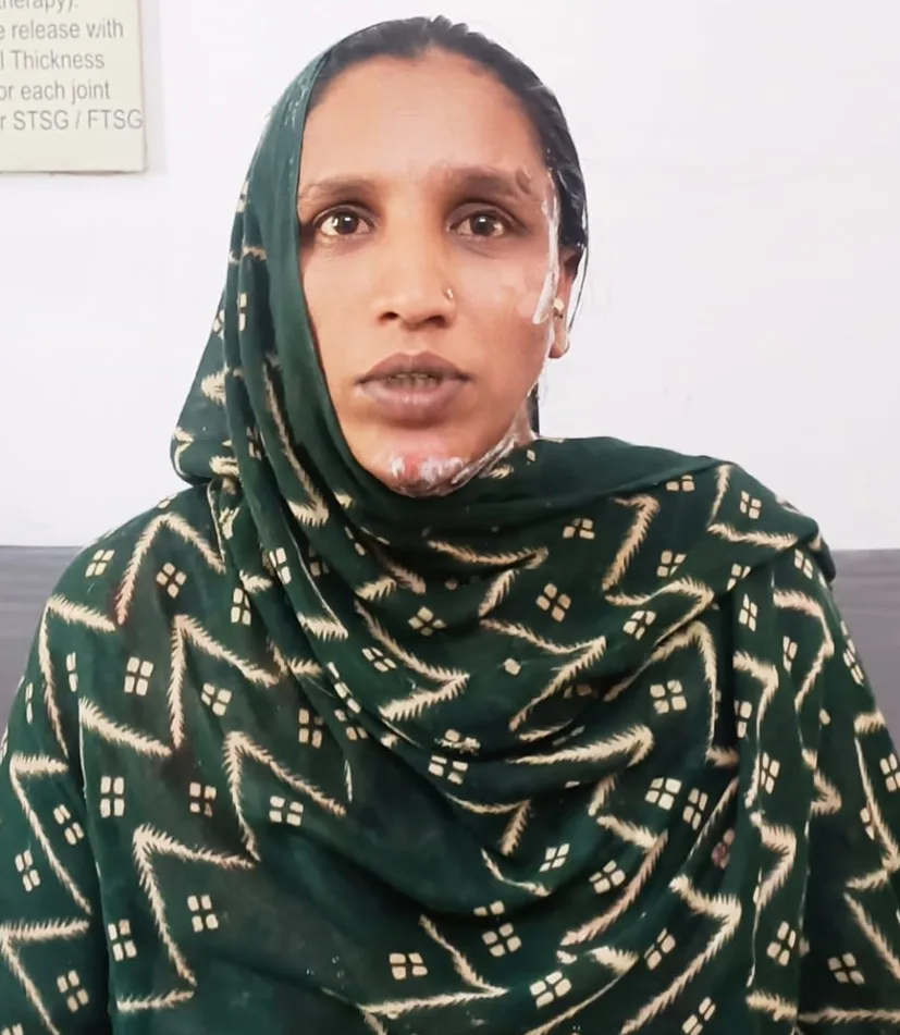 रसोई में गर्म तेल गिरने से झुलसी महिला को मिला नया जीवन